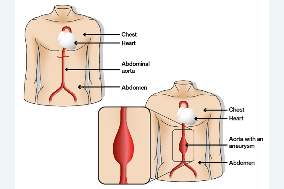 Medical illustration comparing a healthy abdominal aorta to an abdominal aortic aneurysm (AAA) within a human torso. On the left, a torso diagram labels the chest, heart, abdominal aorta, and abdomen, showing a normal, straight red artery. On the right, a second torso diagram labels an "Aorta with an aneurysm," with a magnified inset box highlighting a prominent bulge in the wall of the abdominal aorta.