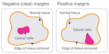 Image: depicting negative (clear) margins and positive margins
