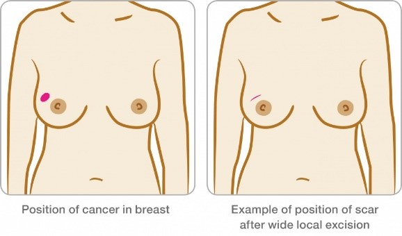 Image: Depicting position of cancer in breast and example of scar position after wide local excision